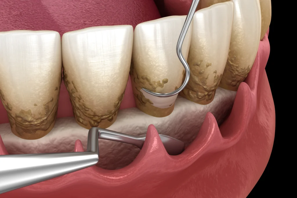 chirurgie assainissement parodontal Soins chirurgicaux des gencives Dr Johan Cinçon, dentiste à La Teste-de-Buch