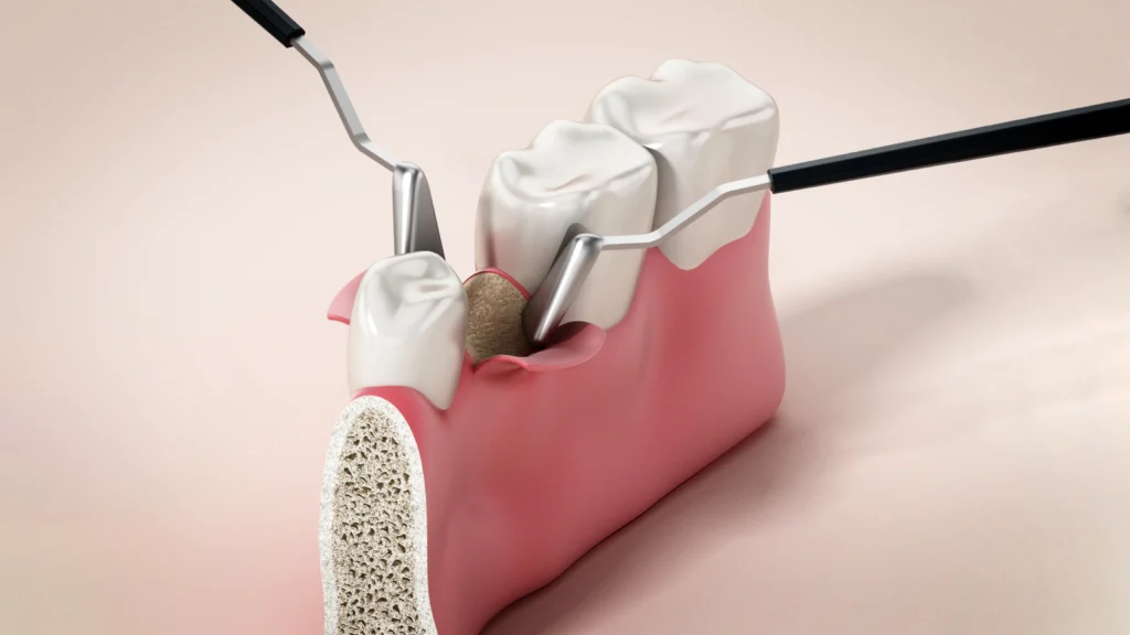 chirurgie orale Chirurgie orale Dr Johan Cinçon, dentiste à La Teste-de-Buch