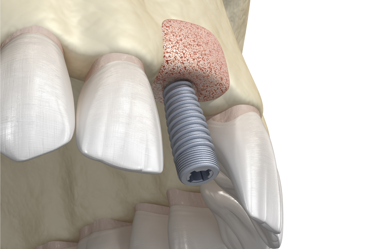 greffe osseuse implant Soins dentaries Dr Johan Cinçon, dentiste à La Teste-de-Buch