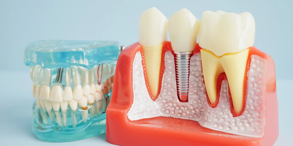 implant dentaire implant dentaire Implants dentaires Dr Johan Cinçon, dentiste à La Teste-de-Buch